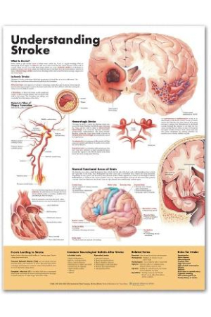 Understanding Stroke Anatomical Chart