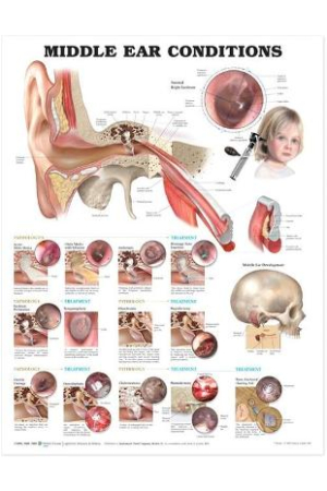 Middle Ear Conditions Anatomical Chart