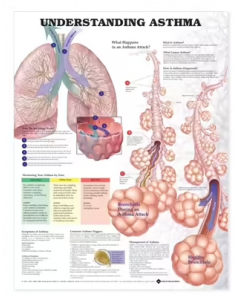 Understanding Asthma Anatomical Chart 